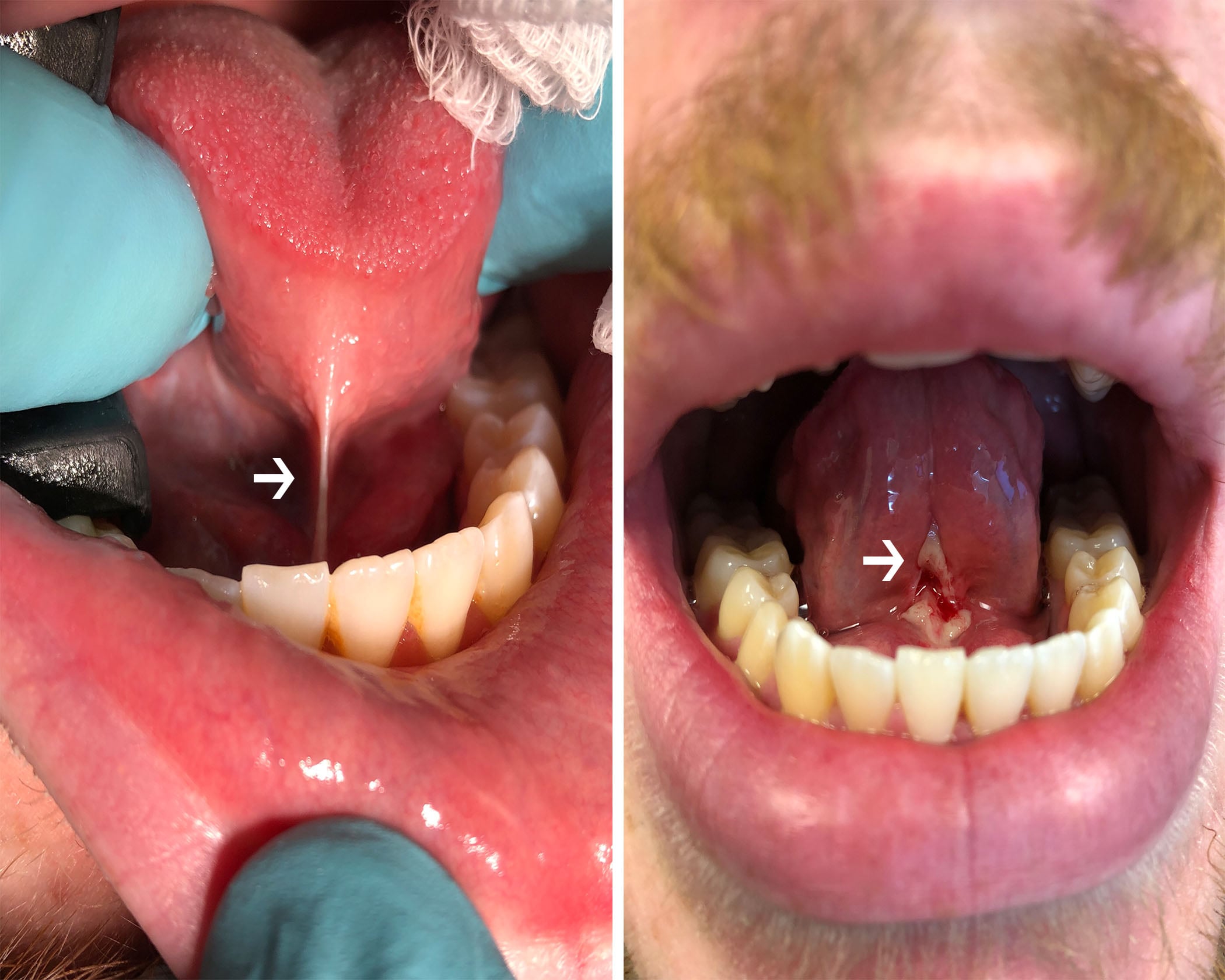 Normal Frenulum Normal Frenulum
