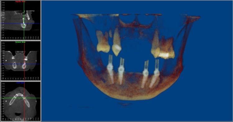 Teeth in an hour screen capture