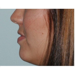 Before Juvederm