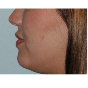 Before Juvederm