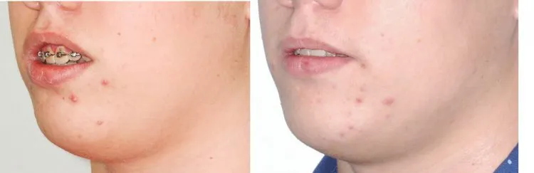 Jaw surgery case study