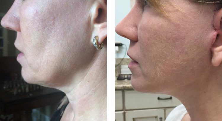 Facelift Case Study