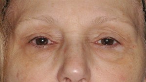 Before Browlift