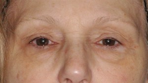 Before Browlift