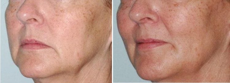 Before and After Voluma®