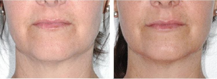Before and After Restaylne Silk®