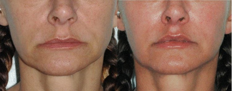 Before and After Restaylne Silk®