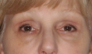 After Browlift