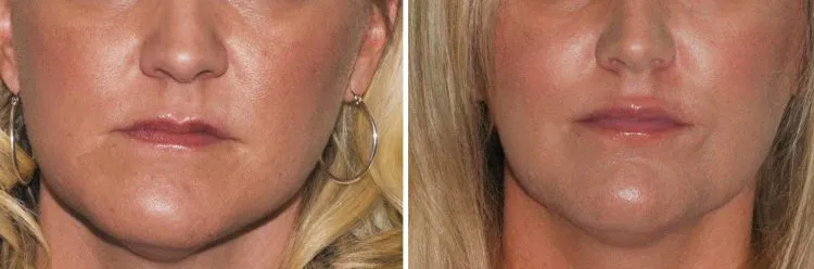 Jaw surgery case study