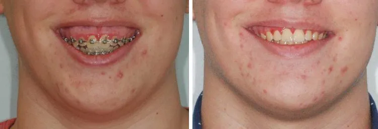 Jaw surgery case study