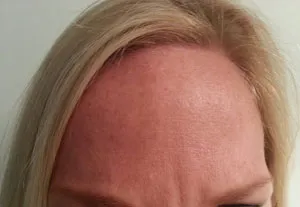 Botox® case study