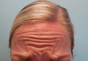 Botox® case study