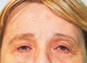 Before Browlift