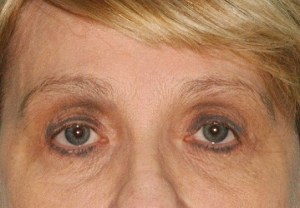 After Browlift