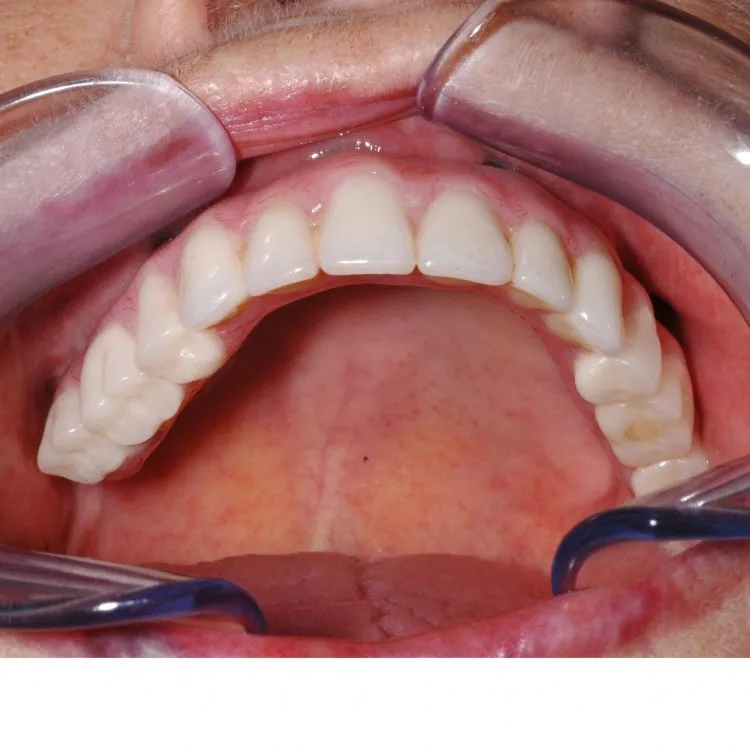Teeth in an hour case - final prosthesis