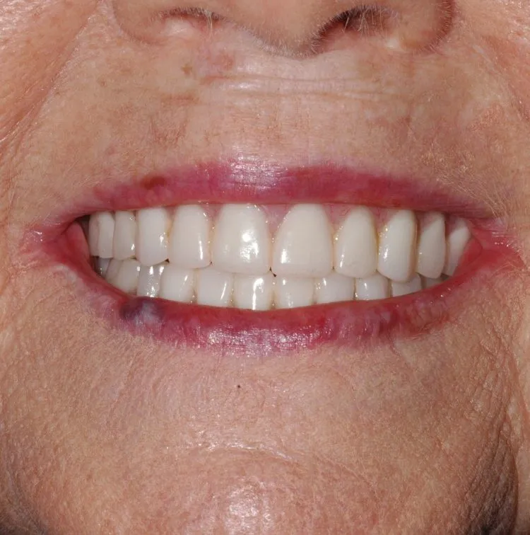 Final teeth look very natural