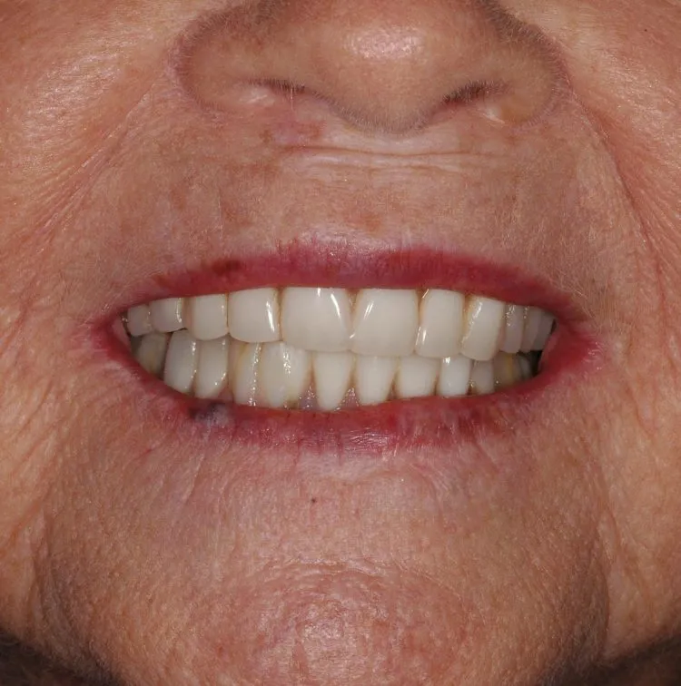 Immediately following surgery with screw retained temporary prosthesis in place