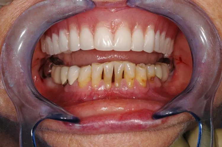 Periodontal disease and multiple failing crowns