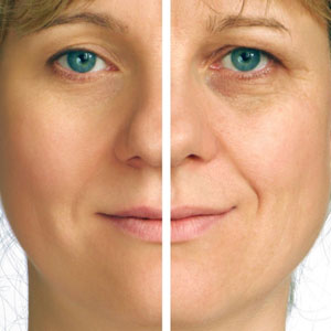 facelift before and after