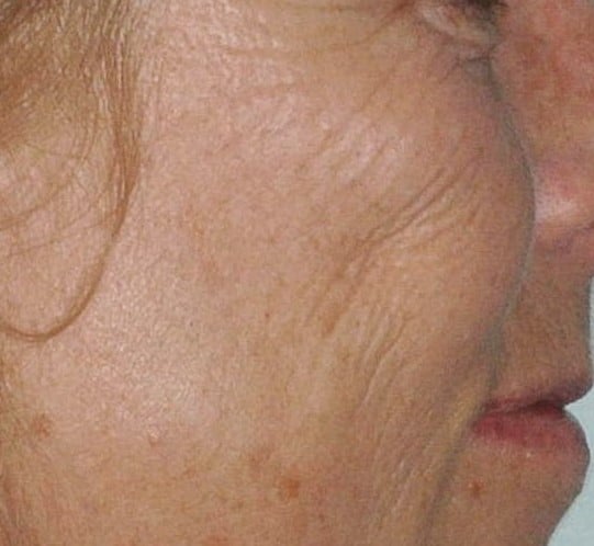 Depression in right cheek.