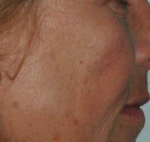 Depression minimized using Juvederm Ultra Plus XC.