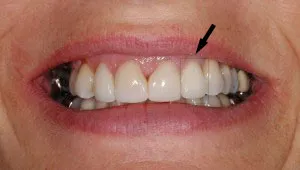 Dental implant example