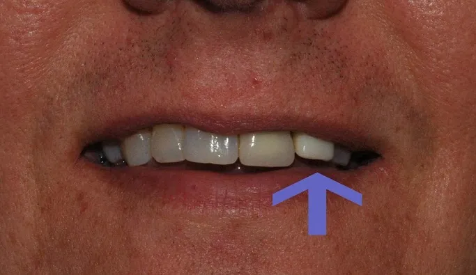 Failing root canal and crown on left lateral incisor