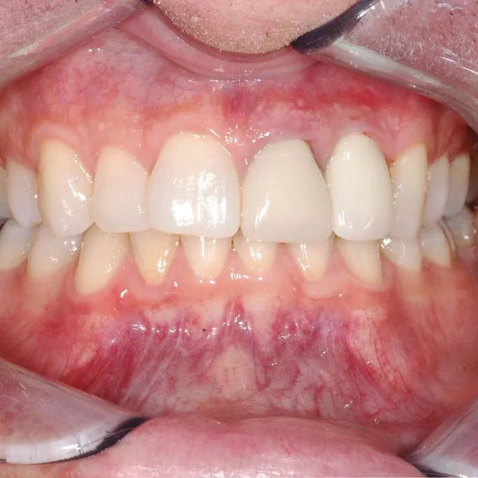 Implant and final crown in place