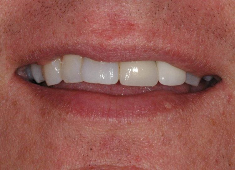  Implant and final crown in place