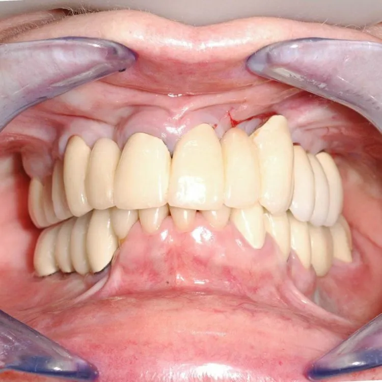 Multiple failing restorations and periodontal disease