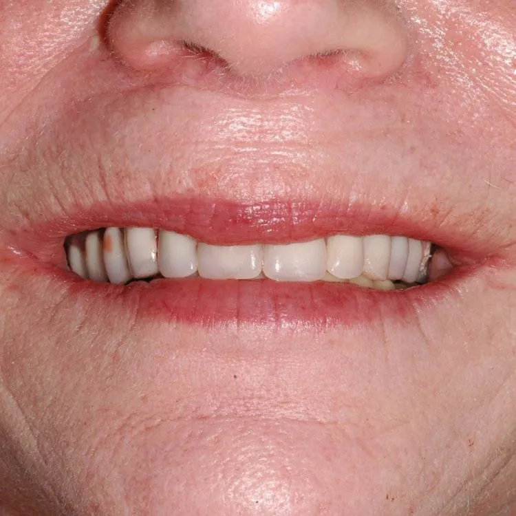 Immediately following surgery with screw retained temporary prosthesis in place