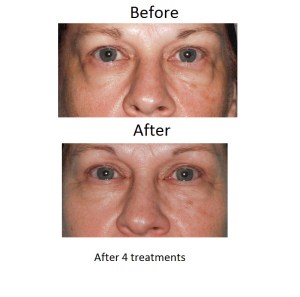 Wrinkle Reduction example