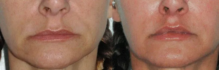 before and after lip lift