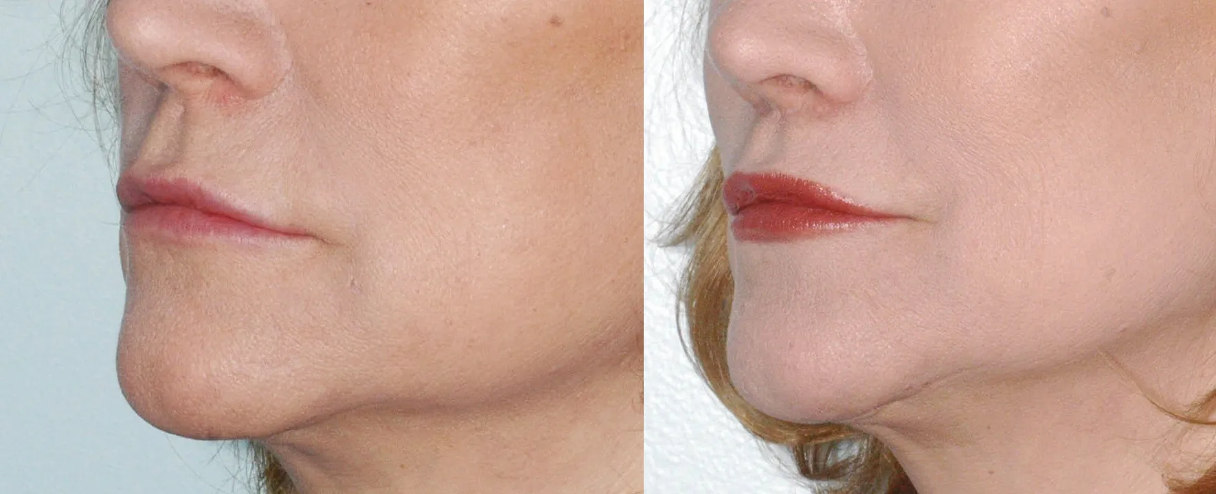 before and after lip lift