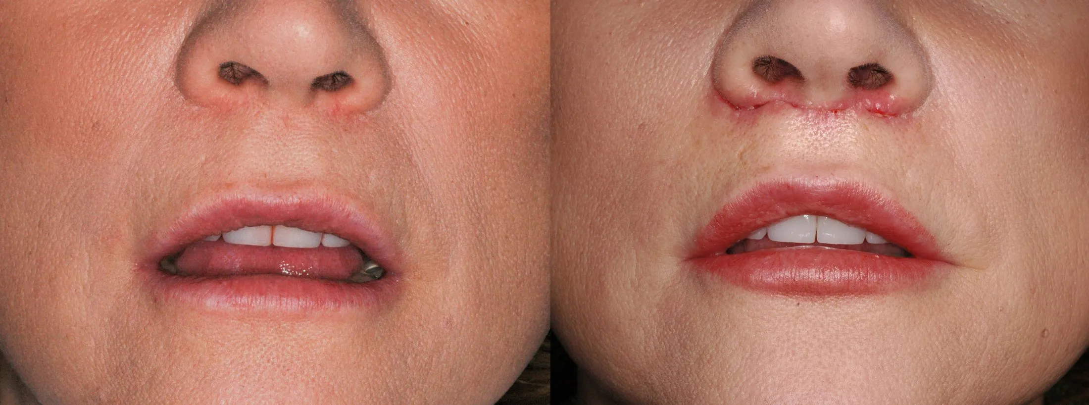 before and after lip lift 2