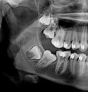 X-ray of un-erupted wisdom teeth