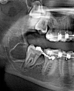 X-ray of un-erupted wisdom teeth