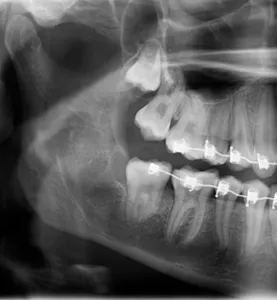 X-ray of erupted wisdom teeth