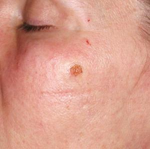 Cosmetic Mole Removal case