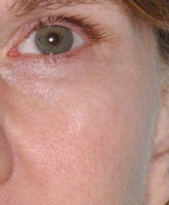 Cosmetic Mole Removal case