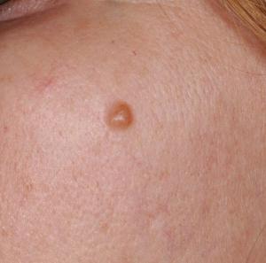 Cosmetic Mole Removal case