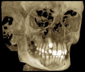  Impacted canines in 3D image