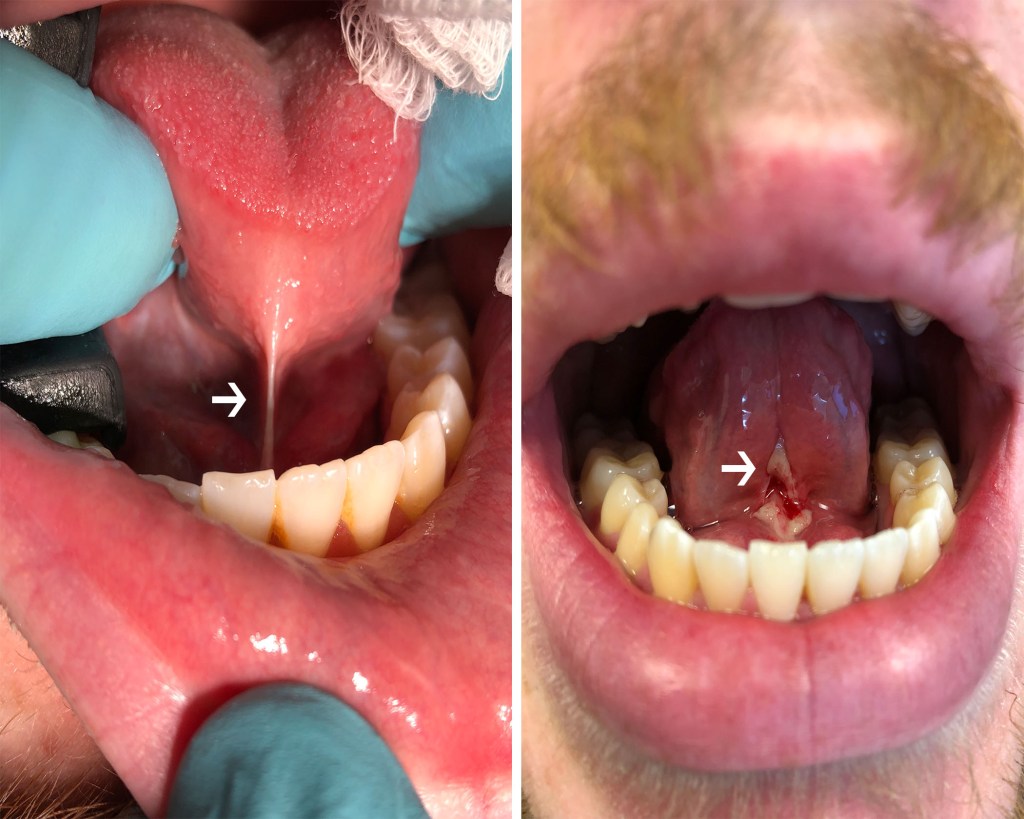 Frenectomy Kernersville - Frenum Surgery Bermuda Run, Improve Speech
