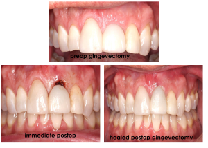 Real denture of a patient