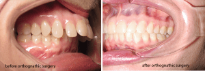 Jaw surgery case study