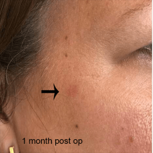 Cosmetic Mole Removal case