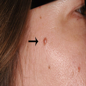Cosmetic Mole Removal case