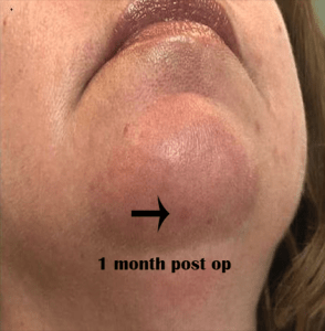 Cosmetic Mole Removal case
