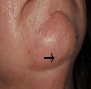 Cosmetic Mole Removal case