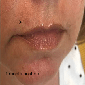 Cosmetic Mole Removal case